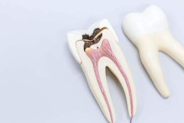 Ask a General Dentist: Is a Tooth Dead After a Root Canal from My Smile Family Dental in Santa Ana, CA