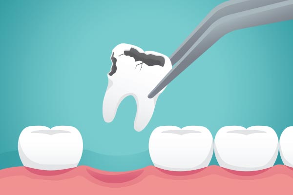 Ask a General Dentist: What Happens to Your Tooth After Extraction from My Smile Family Dental in Santa Ana, CA