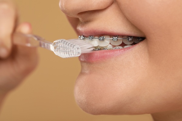 Traditional Braces: A Time Tested Method For Achieving A Perfect Smile