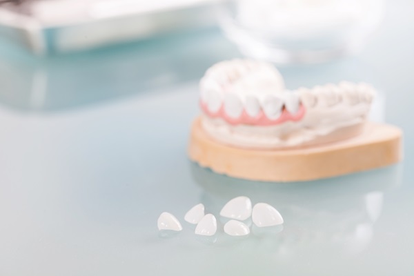 When To Consider Dental Veneers