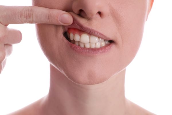 Gum Disease Treatment For Each Stage Of The Disease